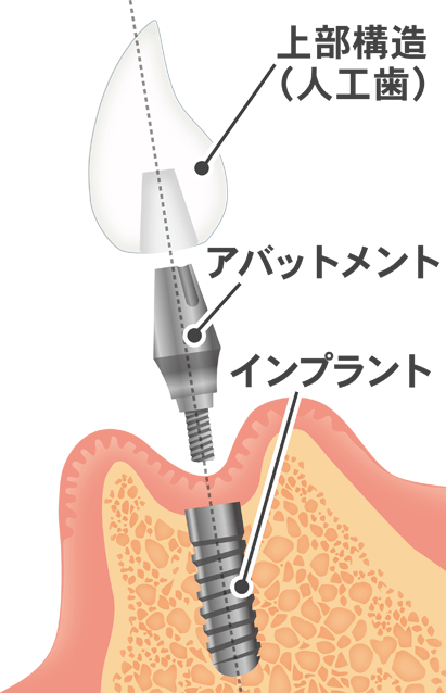 失ってしまった歯を補う治療方法③