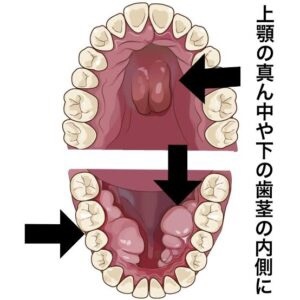 口の中の骨が出っ張る？