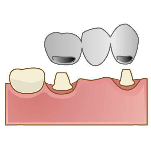 歯を失ってしまった場合の治療方法①